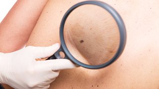 Cancer-killing virus one of two new melanoma treatments