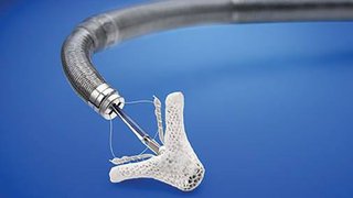 MitraClip therapy: Which patients are ‘sick enough’?