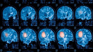 Advancing the Treatment of Brain Tumors