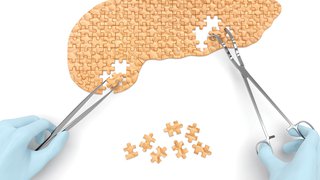 Pancreatic Cancer: Catching It Before It's Too Late