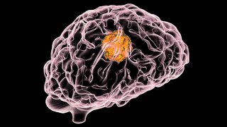 Novel Biomarker-Guided Therapeutics Target Glioma Origins