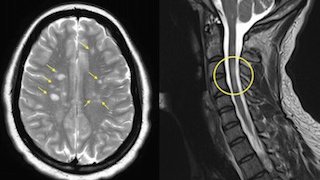 Ocrevus for aggressive MS improves function, reduces disability