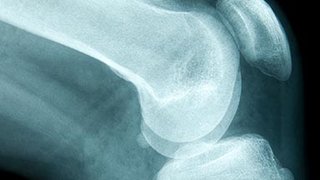 Two-stage knee fusion surgery restores mobility for Texas woman with obesity