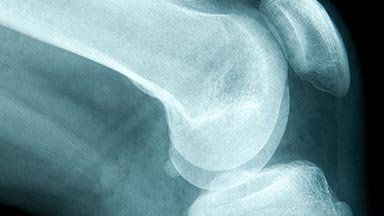 Two-stage knee fusion surgery restores mobility for Texas woman with obesity