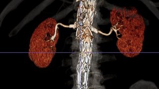 'One of the luckiest guys': Charlie's abdominal aortic aneurysm repair – without open surgery