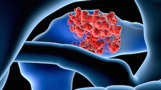 Pancreatic cancer: Symptoms, signs, and treatment