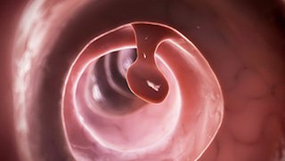 Why are doctors diagnosing fewer cases of colon cancer?