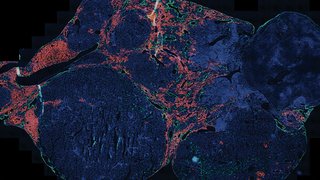 Demystifying Tumor Biology of Hepatocellular Carcinoma