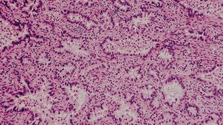 Novel Drug Combination Fights Resistance to TKI Therapy