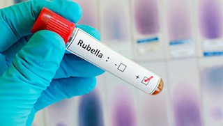 How a recent rubella diagnosis could have been prevented