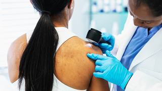 Skin cancer screening: What to look for and when to see a dermatologist