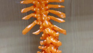 How we 3D-print a model of your spine to enhance complex back surgery
