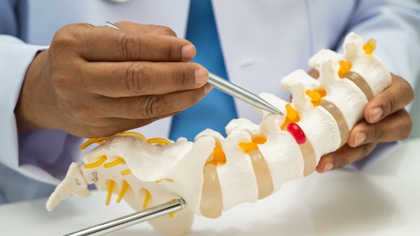 3D-printed spinal implants are customized to relieve your back pain