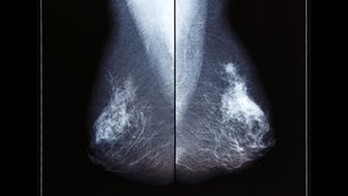 Personalized treatment is key for Stage 0 breast cancer