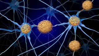 Blood tests for Alzheimer’s disease changing current, future state of dementia care
