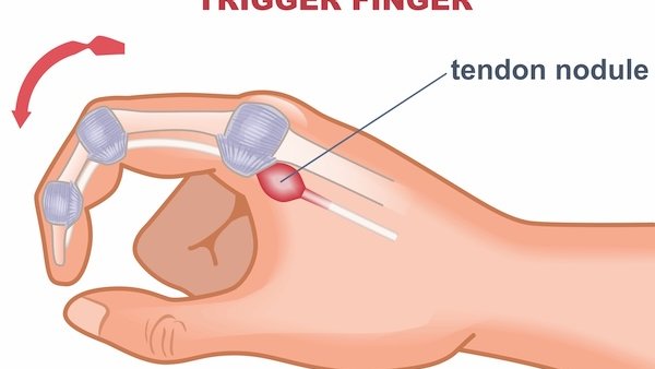 Fixing trigger finger with a fresh approach