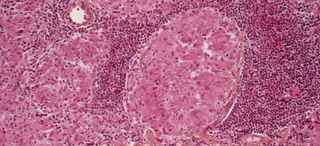 Tuberculosis | Condition | UT Southwestern Medical Center