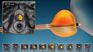 TULSA treats prostate cancer with no incisions, surgery, or radiation