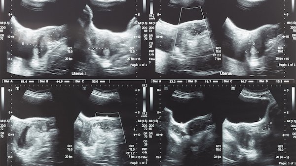 Can uterine fibroids harm my pregnancy?