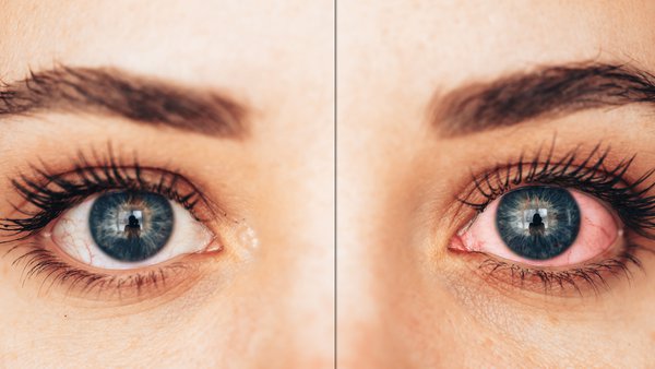 Understanding uveitis: A vision-threatening but treatable eye disease