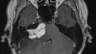 When hearing loss isn’t just about aging: What to know about vestibular schwannomas