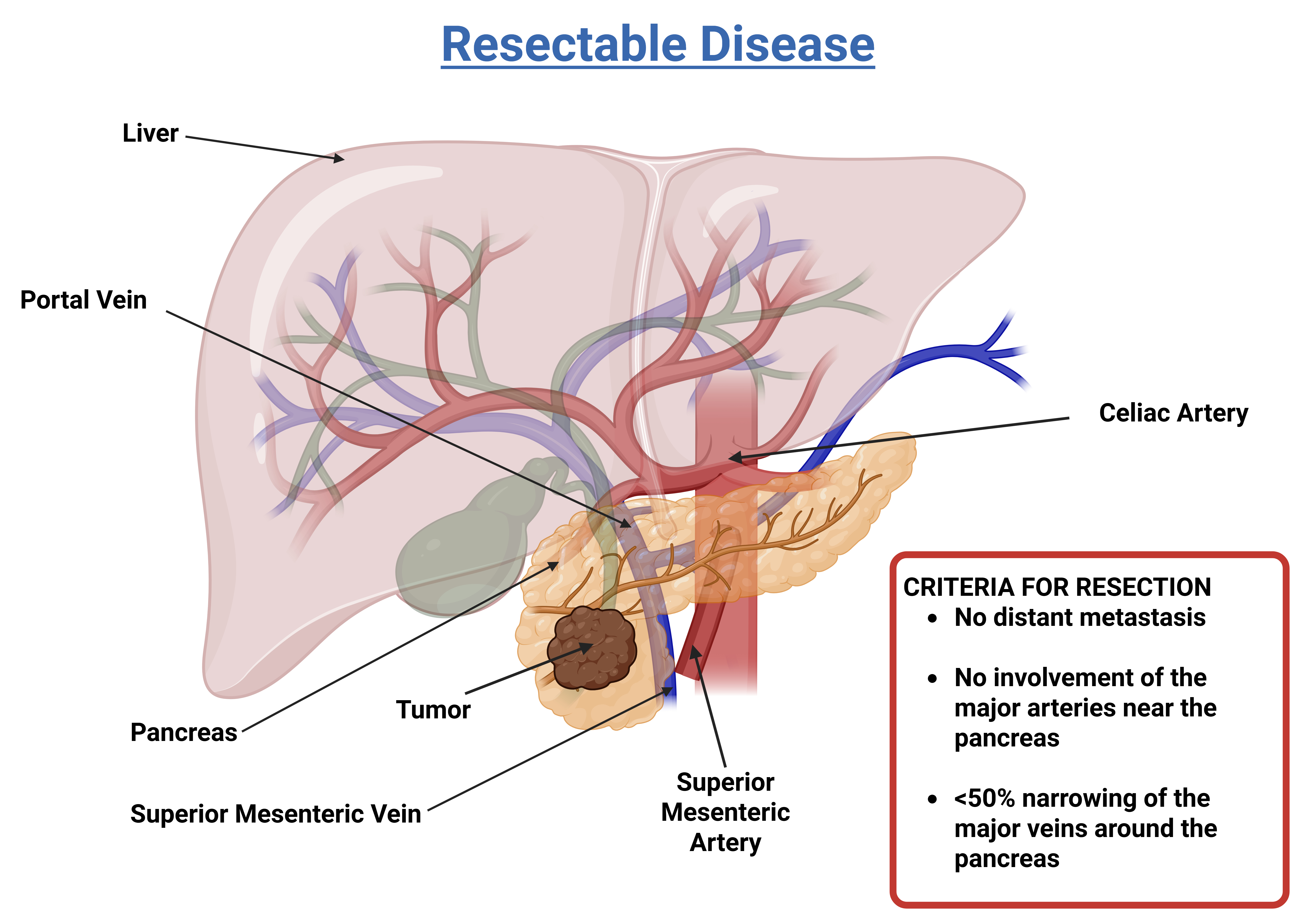 illustration - pancreatic cancer resectable stage