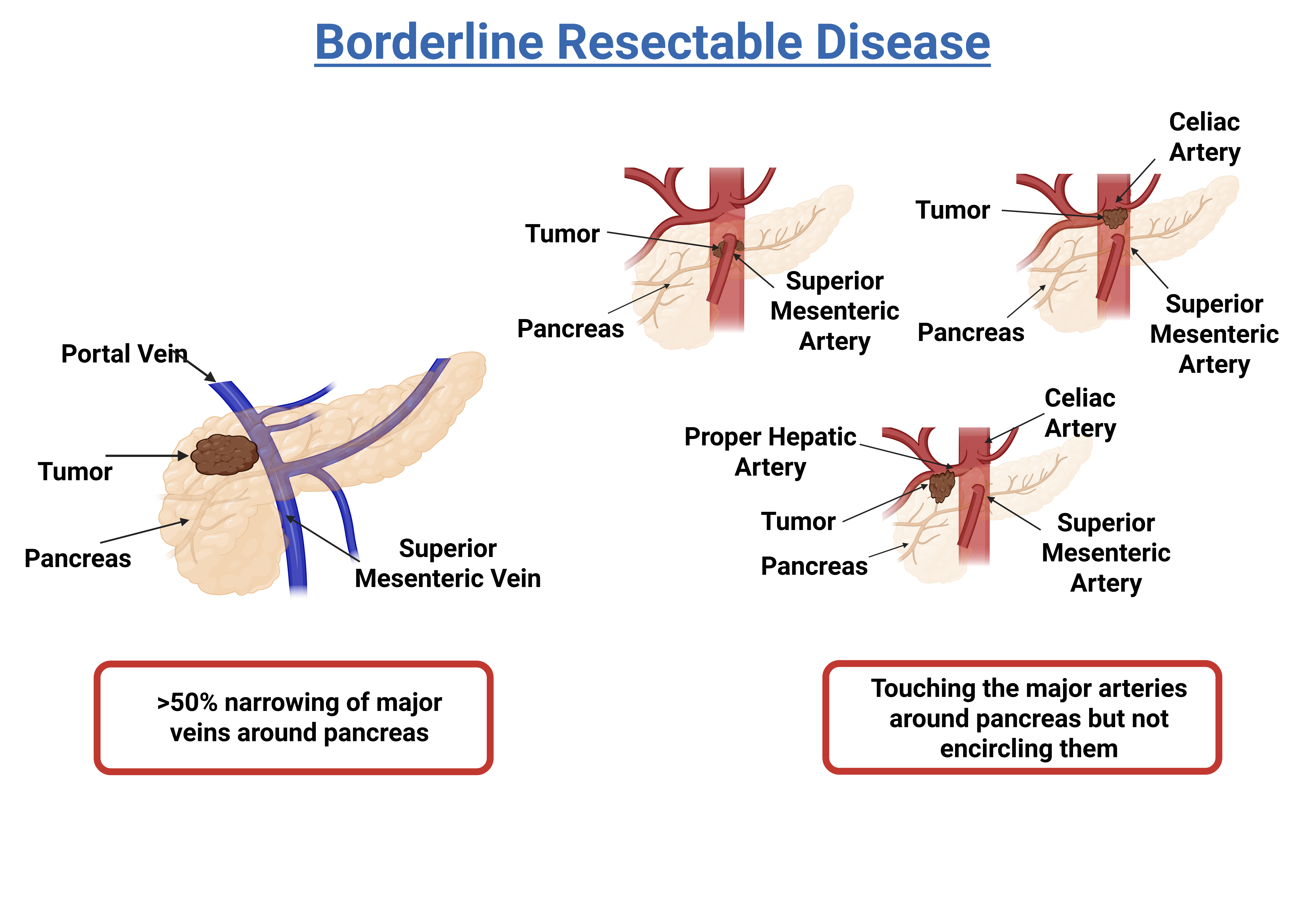 illustration - pancreatic cancer borderline stage