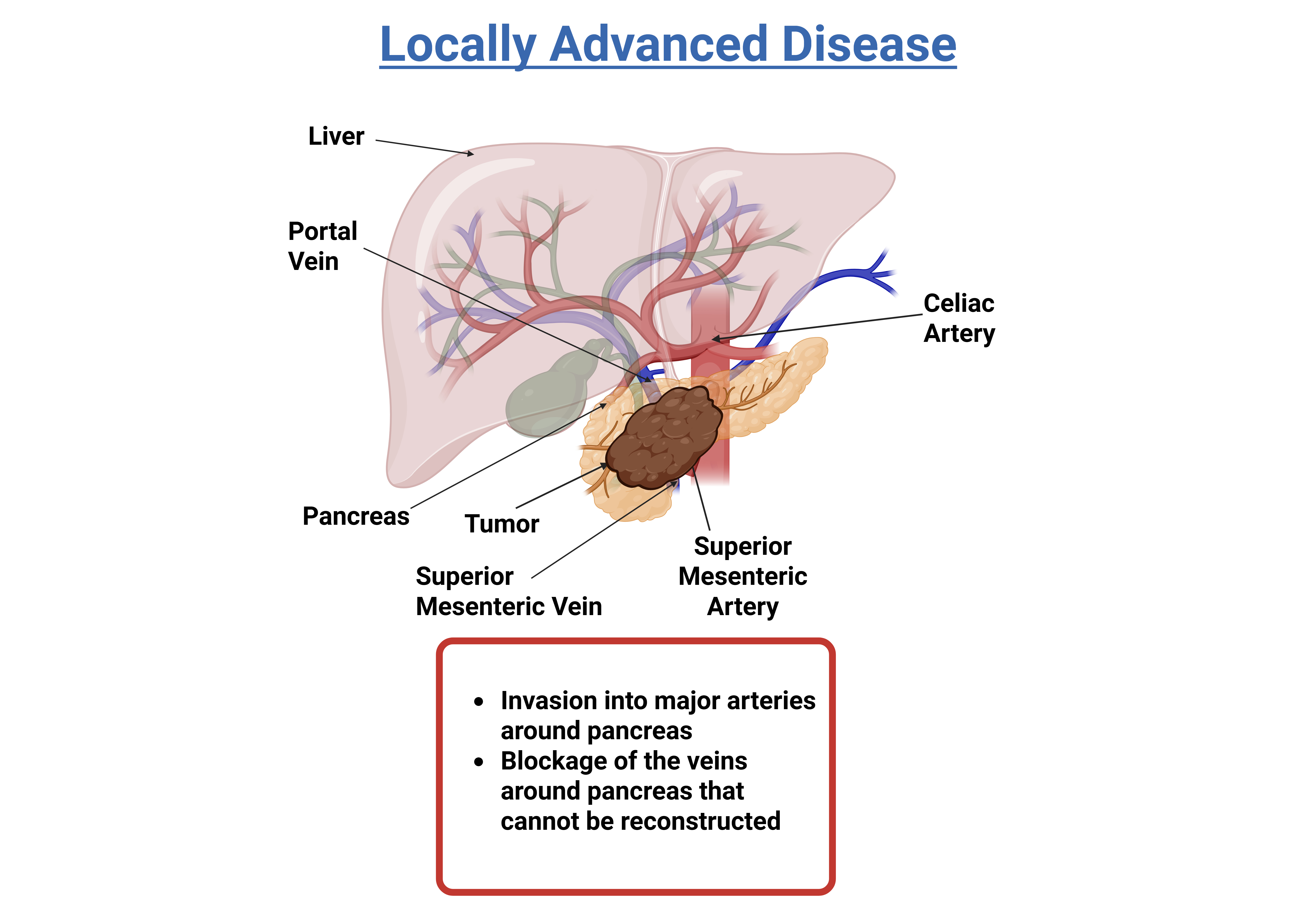 illustration - pancreatic cancer locally advanced stage