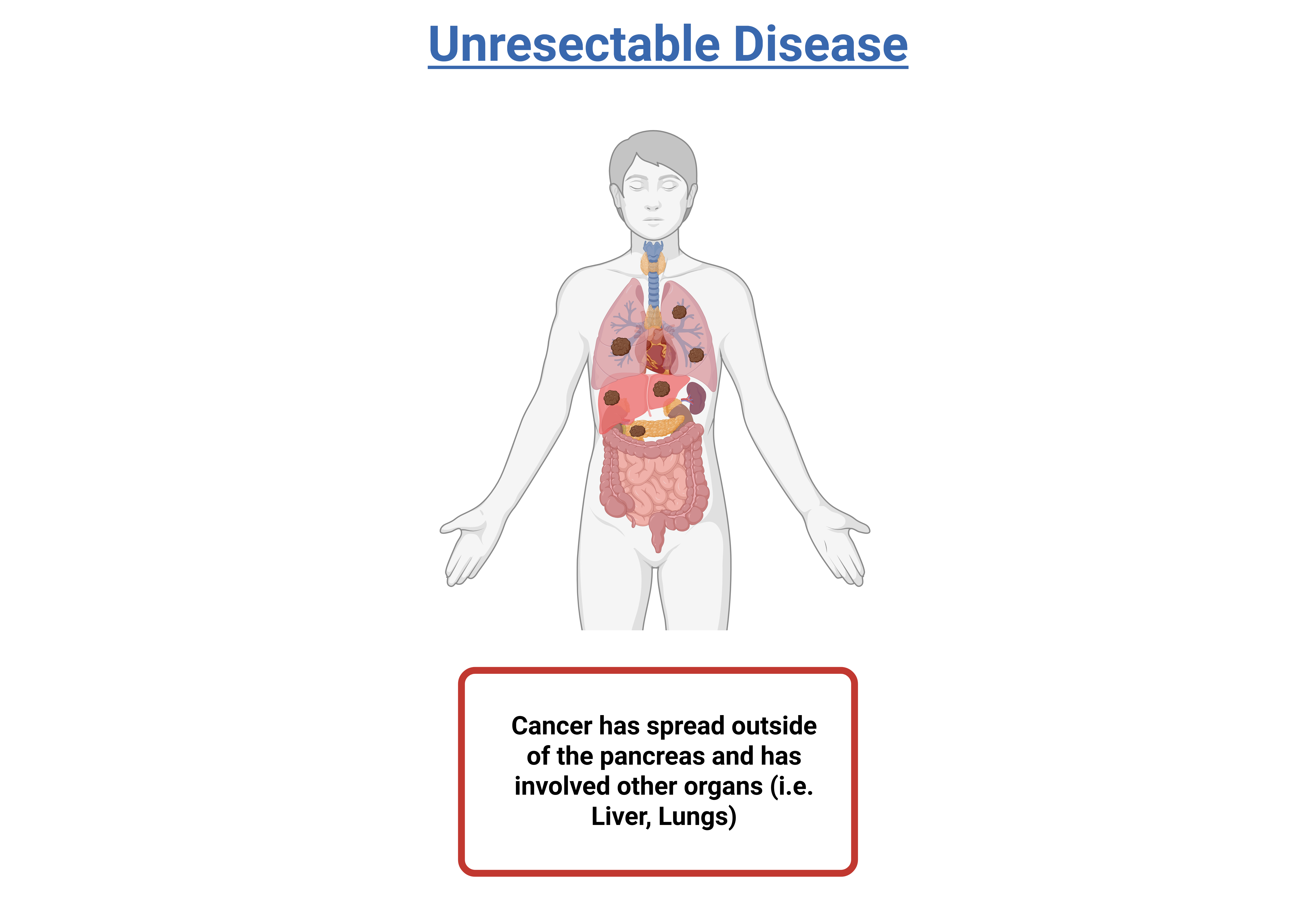 illustration - pancreatic cancer metastatic stage