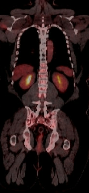 PET/CT scan before stem cell transplant for Clinton Adger