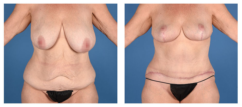 before and after photos (front view) of patient who had a Lipoabdominoplasty (Liposuction and Abdominoplasty) and Breast Lift Surgery After Massive Weight Loss.