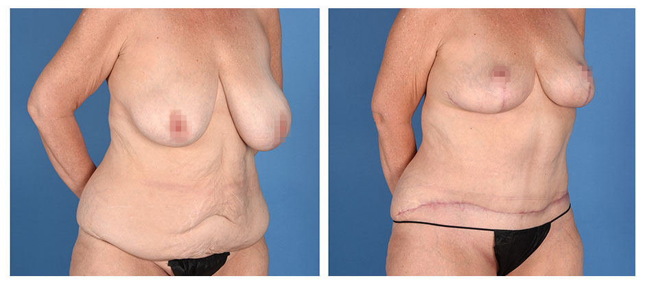 before and after photos (side full body) of patient who had a Mommy Makeover, Including Breast Lift and Abdominoplasty (Tummy Tuck).