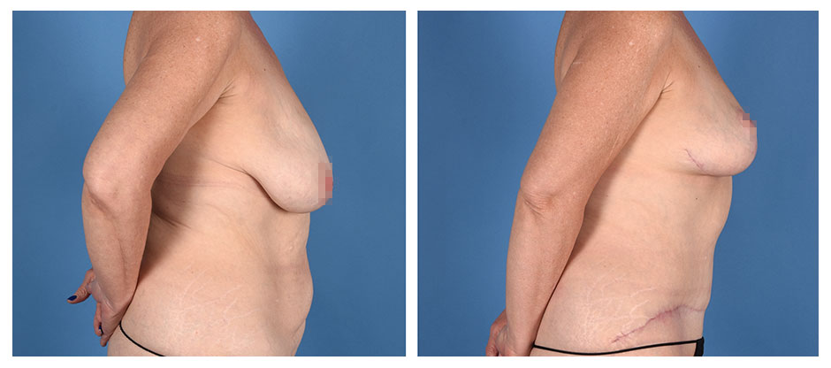 before and after photos (profile view) of patient who had a Lipoabdominoplasty (Liposuction and Abdominoplasty) and Breast Lift Surgery After Massive Weight Loss.