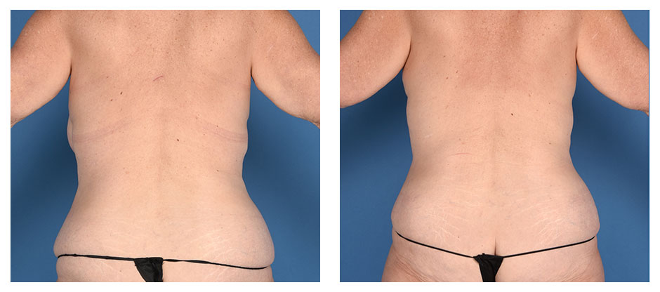 before and after photos (back view) of patient who had a Lipoabdominoplasty (Liposuction and Abdominoplasty) and Breast Lift Surgery After Massive Weight Loss.