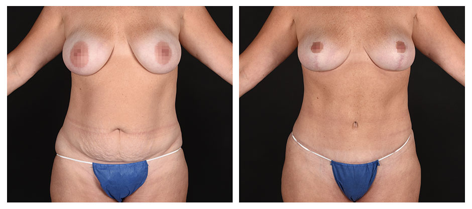 before and after photos (frontn view) of patient who had a Abdominoplasty (Tummy Tuck) and Breast Lift – Mommy Makeover.