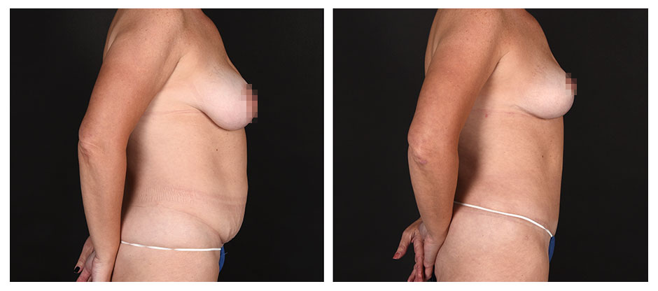 before and after photos (profile view) of patient who had a Abdominoplasty (Tummy Tuck) and Breast Lift – Mommy Makeover.