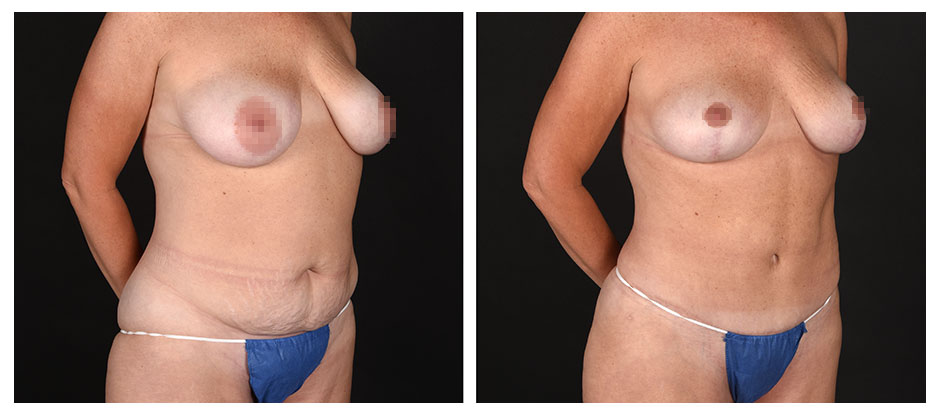 before and after photos (side view) of patient who had a Abdominoplasty (Tummy Tuck) and Breast Lift – Mommy Makeover.