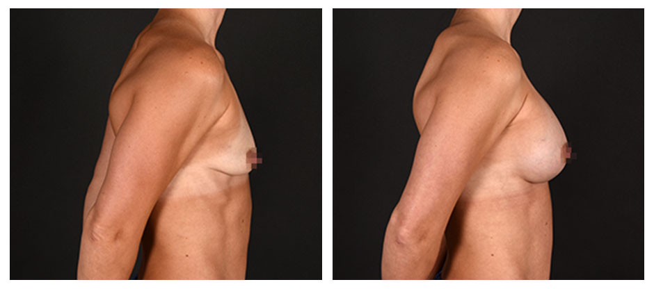before and after photos (profile view) of patient who had Breast Augmentation.
