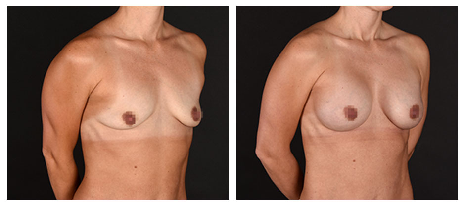 before and after photos (side view) of patient who had Breast Augmentation.
