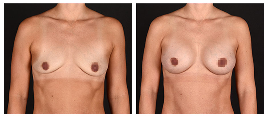 before and after photos (front view) of patient who had Breast Augmentation.