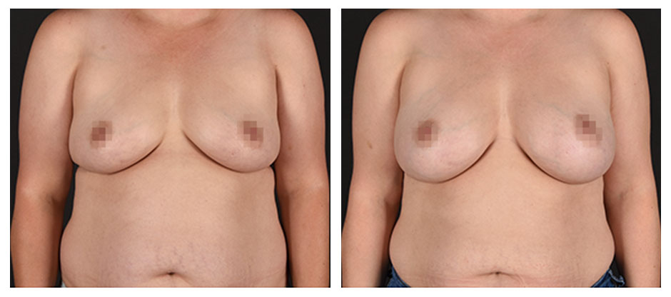 before and after photos (front view) of patient who had Breast Augmentation.