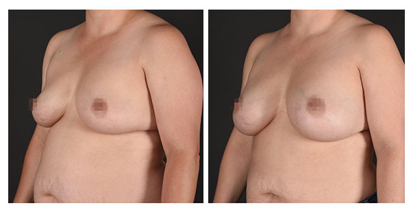 before and after photos (side view) of patient who had Breast Augmentation.
