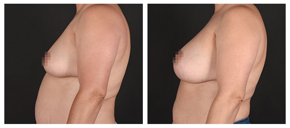 before and after photos (profile view) of patient who had Breast Augmentation.