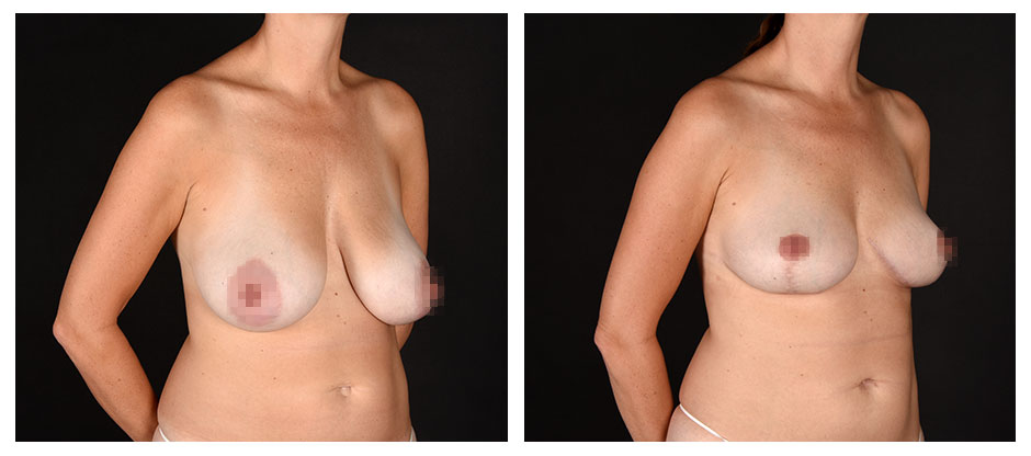 before and after photos (side view) of patient who had a Breast Lift.