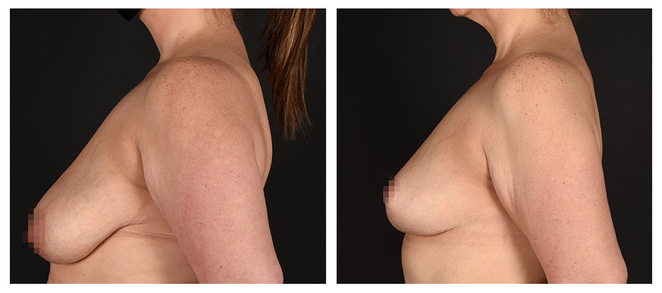 before and after photos of patient who had a Breast Lift.
