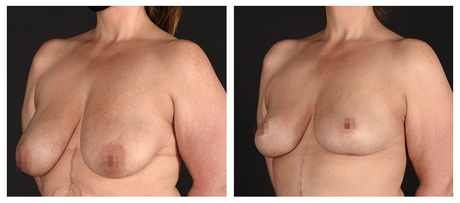 before and after photos (side view) of patient who had a Breast Lift.