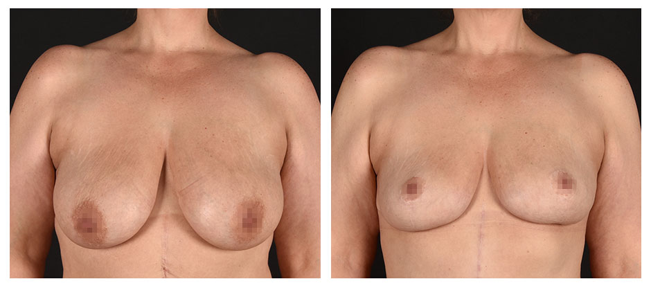 before and after photos (front view) of patient who had a Breast Lift.