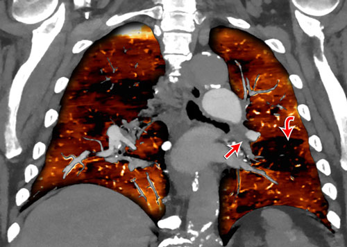 Chronic thromboembolic pulmonary hypertension CT scan