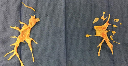 Image of Chronic thromboembolic pulmonary hypertension clot.
