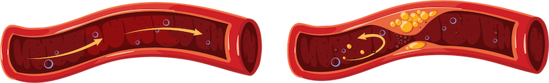 Two red and yellow wavy shapes representing cholesterol plaque.